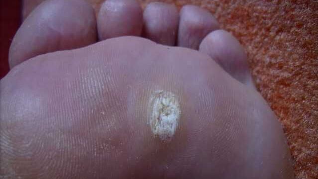 Verruche, cosa sono e come si riconoscono?