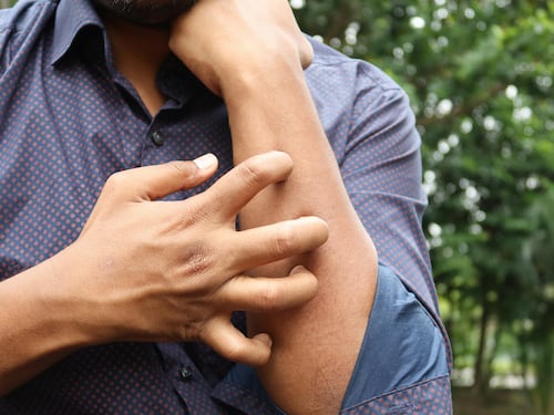Dermatite atopica, come riconoscere la malattia della pelle più diffusa in assoluto