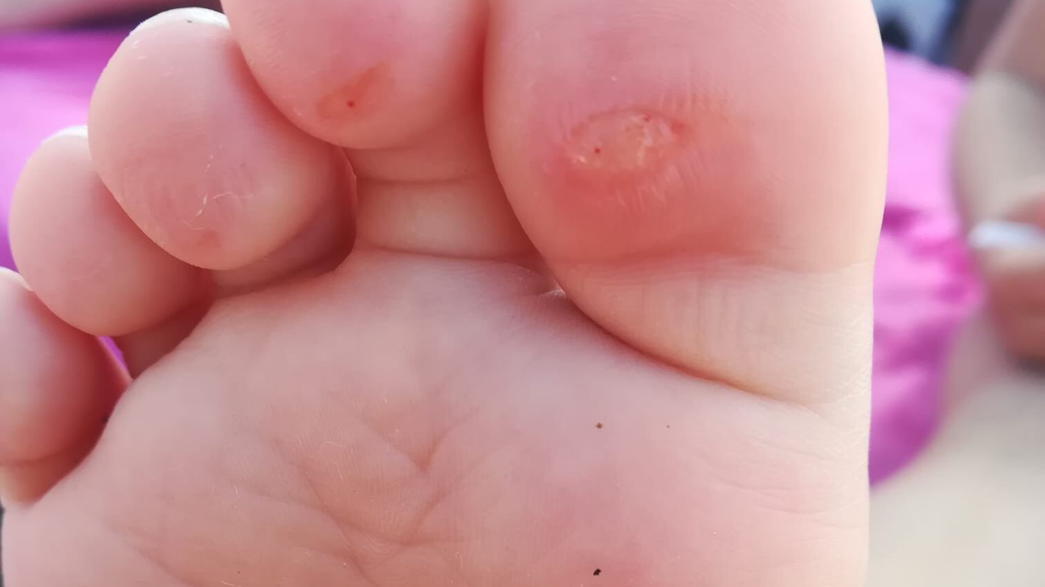 Pareo Park, 150 bambini colpiti da infezione: bolle e sangue sui piedi