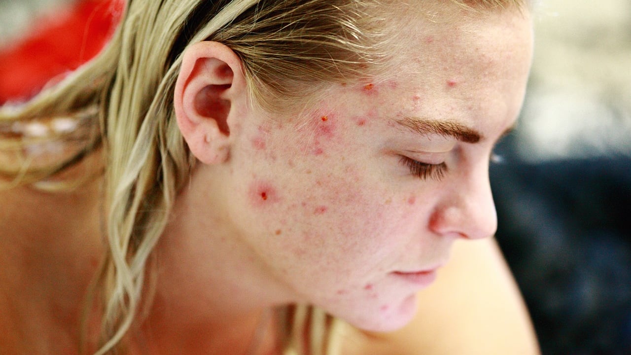 Acne, prendere il sole fa male o è salutare?
