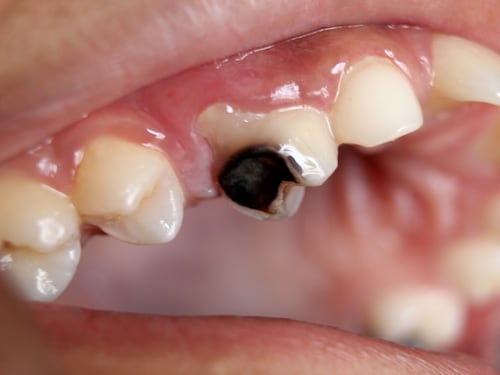 Carie, un nemico che può causare malattie al cuore e ad altri organi