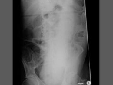 Pazze radiografie: gli oggetti che possono finire nel corpo umano 3