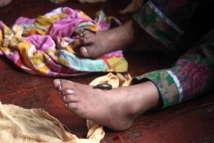 La terapia delle sanguisughe nel Kashmir indiano 15