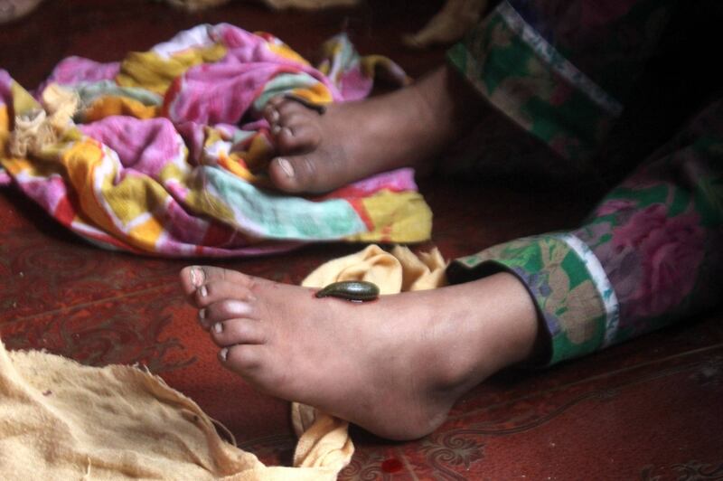La terapia delle sanguisughe nel Kashmir indiano 15