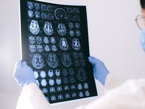 Ridurre l’insorgenza di demenza dopo i 60 anni: quali fattori di rischio evitare