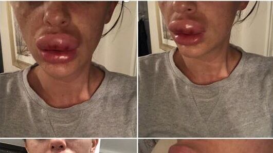 L'iniezione di botox tocca l'arteria: le labbra diventano enormi