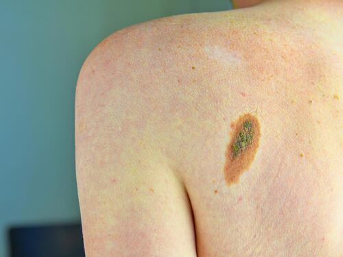 Melanoma in stadio avanzato, grazie a terapie migliora sopravvivenza