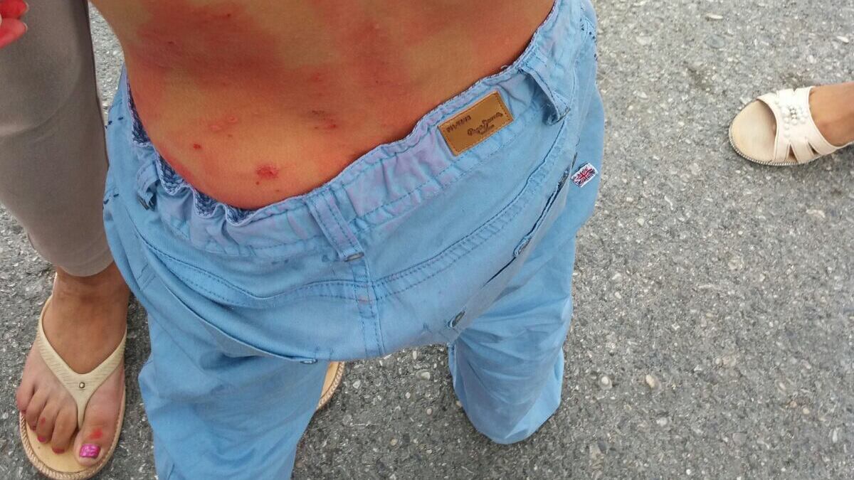 Castel Romano, allarme scabbia nel campo rom: "Rischio epidemia"