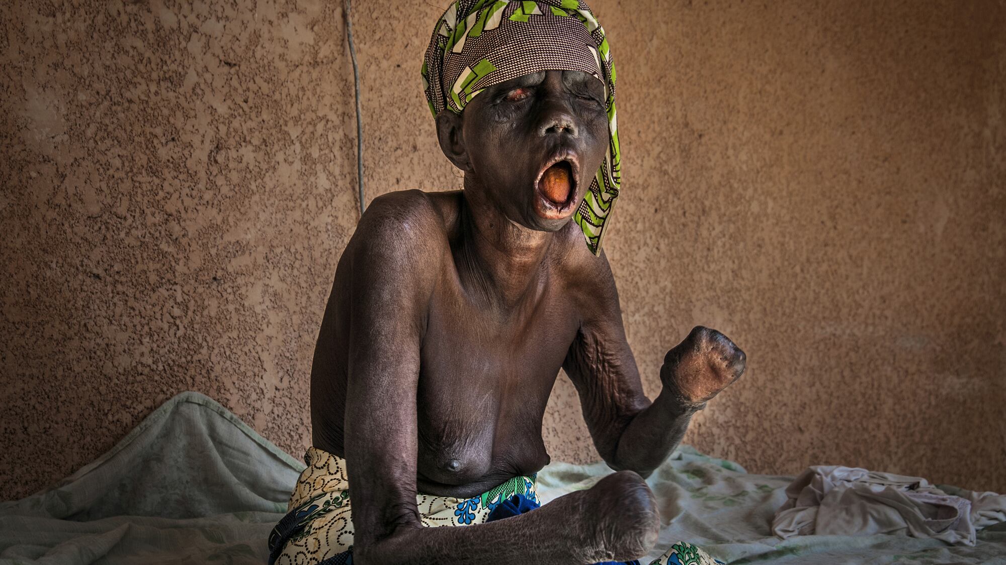 Tra i malati di lebbra dimenticati da tutti nell'Africa profonda