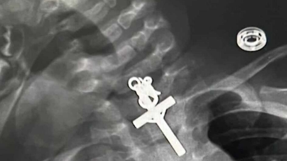 Ingoia un crocifisso e le resta incastrato in gola: bimba di dieci mesi sotto i ferri