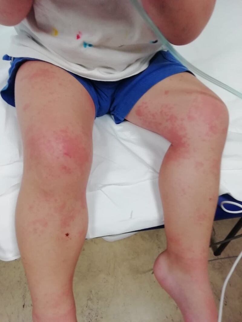 Pescara, bimbo allergico in ospedale dopo aver mangiato budino 1