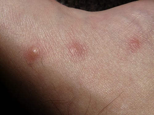 Orticaria, in Italia ne soffrono 5 milioni