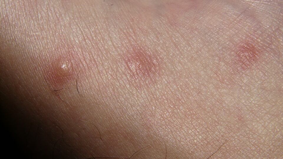 Orticaria, in Italia ne soffrono 5 milioni