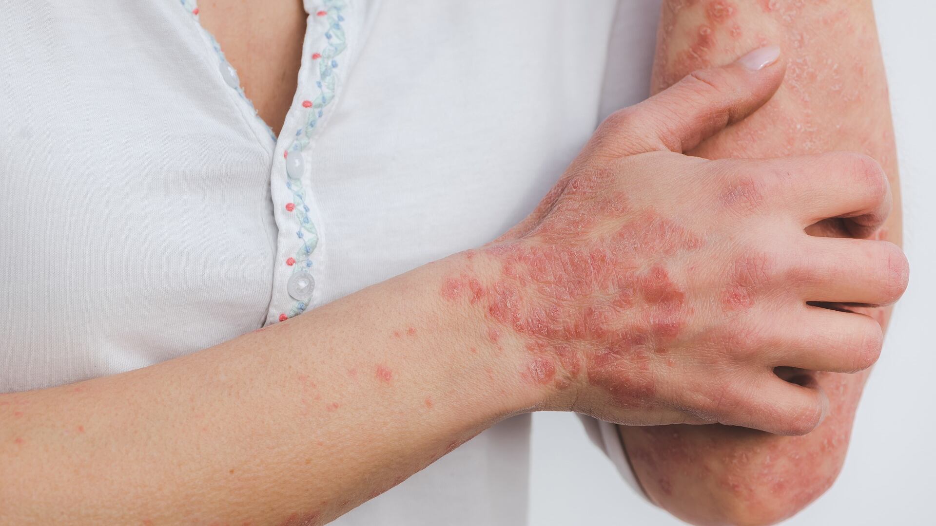Psoriasi: perché a 60 anni è più frequente e come curarla