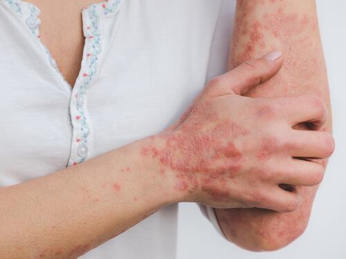 Psoriasi: perché a 60 anni è più frequente e come curarla