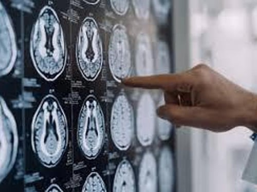 Morbo di Parkinson, cos’è e quali sono i sintomi