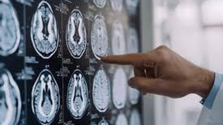 Centro Dbs Pavia, 100 interventi di neurostimolazione profonda per Parkinson