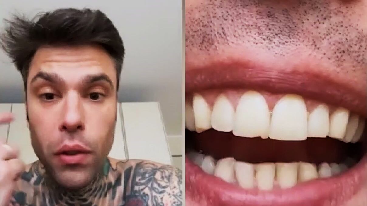 "Un pulmino per Lourdes?": Fedez, il pungo e il dente scheggiato: cos'è successo