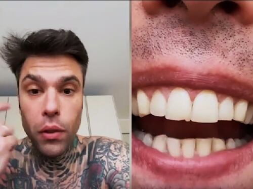 "Un pulmino per Lourdes?": Fedez, il pungo e il dente scheggiato: cos'è successo