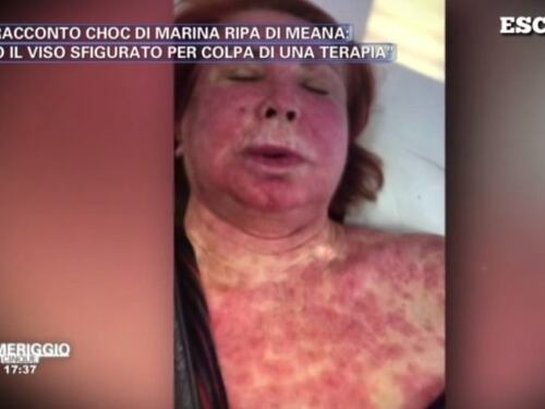Pomeriggio 5, Marina Ripa di Meana sfigurata: "Ho il volto sfregiato a causa di una terapia"