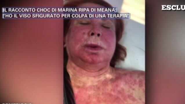 Pomeriggio 5, Marina Ripa di Meana sfigurata: "Ho il volto sfregiato a causa di una terapia"