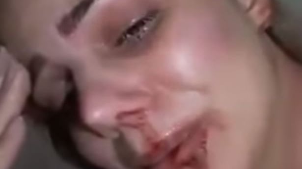 Renata Lustosa massacrata di botte dall'ex: "Cosa faccio con un mostro così?"