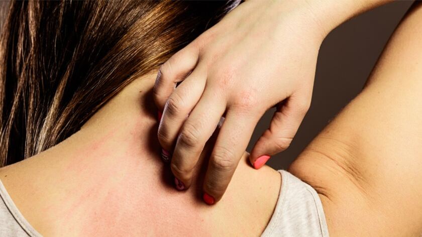 Differenze tra eczema e orticaria