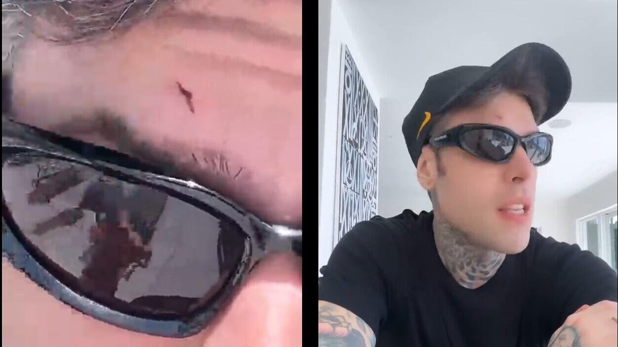 Fedez a Miami, infortunio e valigia persa: un viaggio da incubo