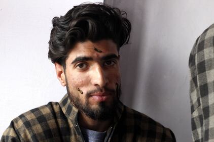 La terapia delle sanguisughe nel Kashmir indiano 19