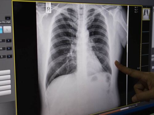 Bimbo di 5 anni contagiato da tubercolosi ricoverato in ospedale