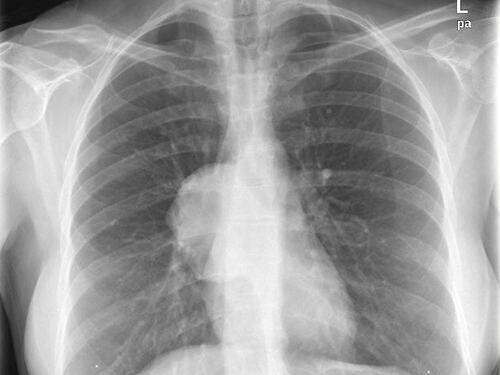 Mesotelioma pleurico, cos'è e come si manifesta