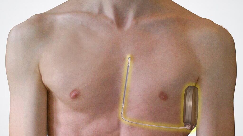 Defibrillatore sottocutaneo, cos'è e come funziona il dispositivo impiantato a Bove