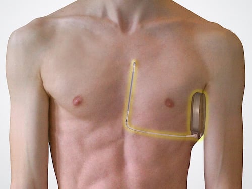 Defibrillatore sottocutaneo, cos'è e come funziona il dispositivo impiantato a Bove