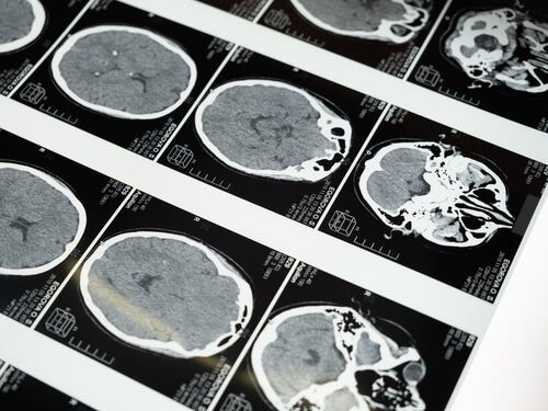 Estratto verme vivo dal cervello di una donna: primo caso al mondo