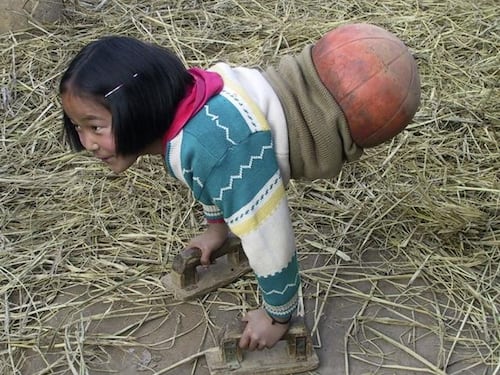 Qian Hongyan, "Basketball Girl": la bambina con una palla al posto delle gambe è una nuotatrice professionista