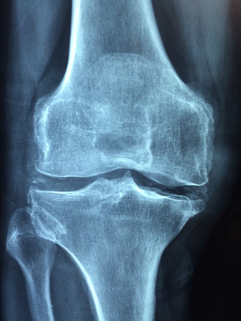 Radiografia ginocchio