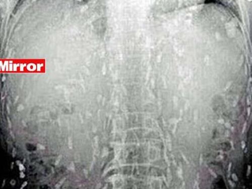 Scienze, caso unico: la tenia cancerogena uccide un uomo