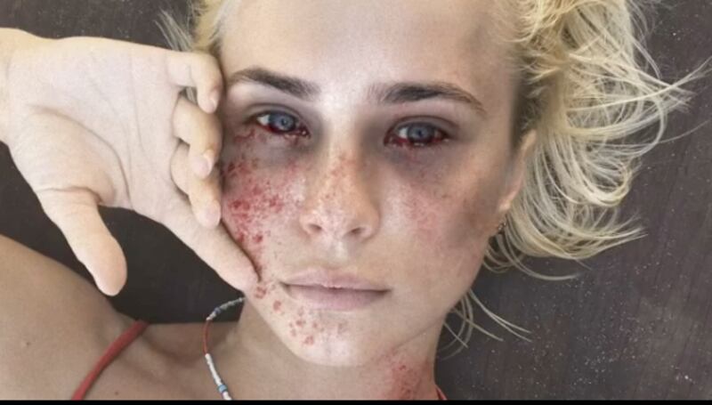 Modelle come malate di Ebola: la campagna choc delle ong olandesi 1