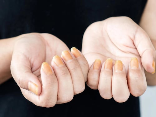 Scoperta la causa principale della Sindrome dell’unghia gialla: di cosa si tratta