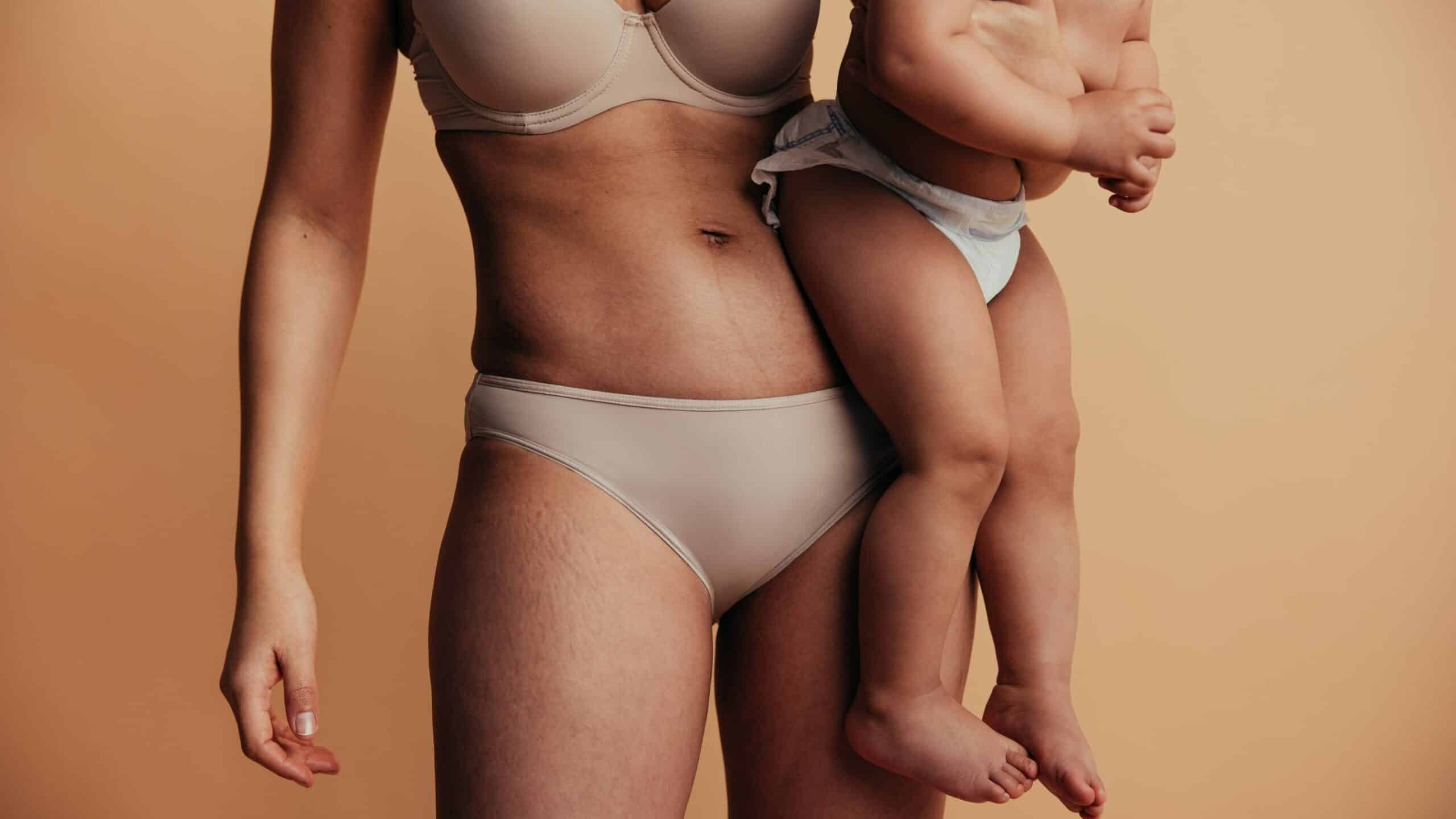 Smagliature in gravidanza: come prevenirle e curarle