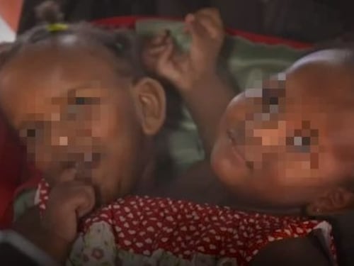 Due gemelle siamesi vicine alla morte, il papà: "Non scelgo chi salvare"