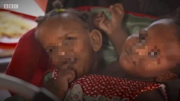 Due gemelle siamesi vicine alla morte, il papà: "Non scelgo chi salvare"