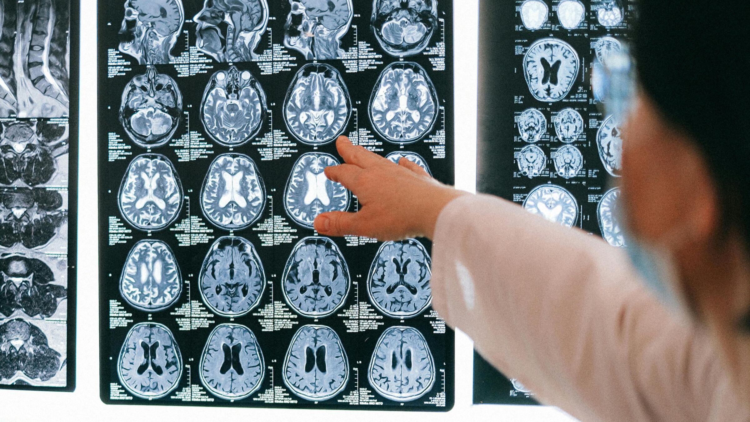 Ictus, la regola FAST e tutti i sintomi da non sottovalutare