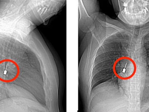 Cacciavite odontoiatrico incastrato nei bronchi di una donna. "È stato inalato per sbaglio"