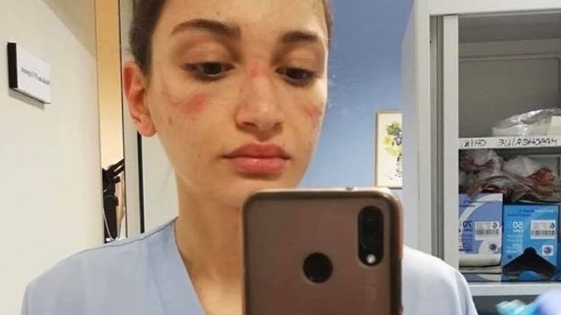 L'infermiera con il volto segnato dalla mascherina: "State in casa"