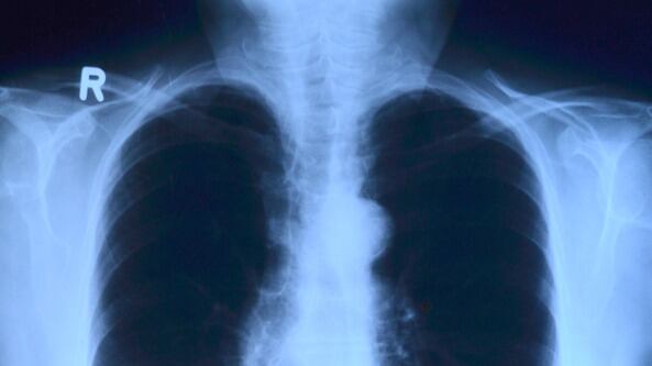 Legionella: cos'è la malattia che colpisce i polmoni