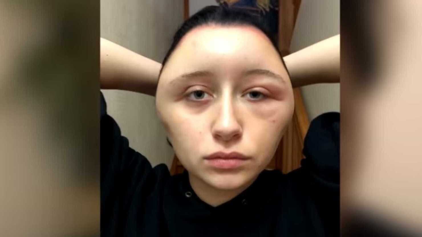 Ha una reazione allergica dopo tintura per capelli: la faccia si gonfia di 63 cm