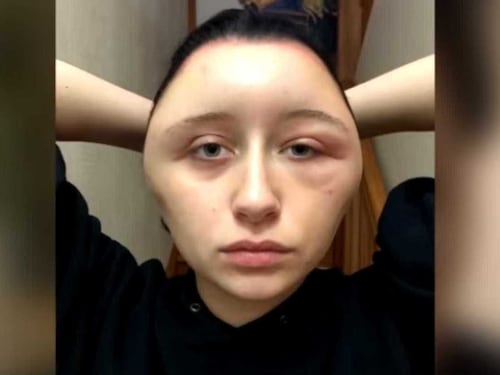 Ha una reazione allergica dopo tintura per capelli: la faccia si gonfia di 63 cm