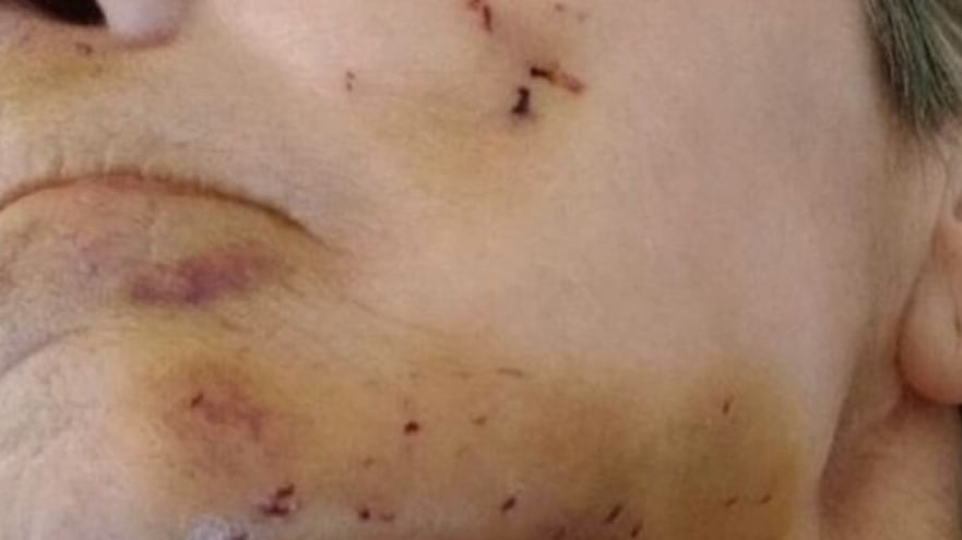 Topo "mangia il viso" a una disabile paralizzata a letto