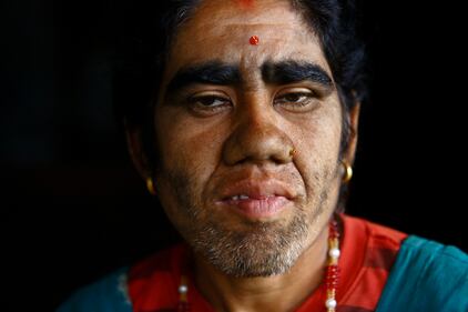 Nepal, soffrono di una malattia che li rende pelosissimi 4